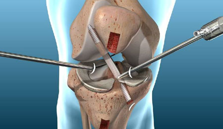 ACL / PCL Reconstruction