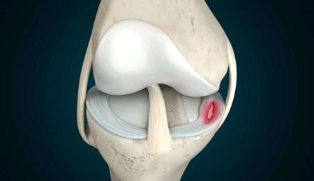 Meniscus Repair Surgery