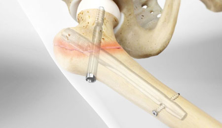 Complex Fracture Fixation Surgery