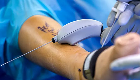 Minimally Invasive Fracture Surgery