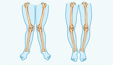 Deformity Correction Surgery