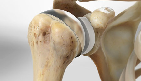 Shoulder Replacement Surgery