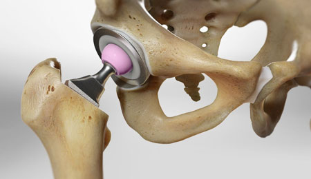Hip Replacement Surgery