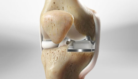 Partial Knee Replacement