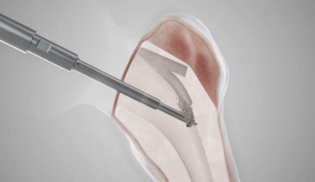 Revision Arthroplasty Surgery