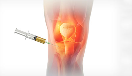 PRP Therapy for Joint Preservation