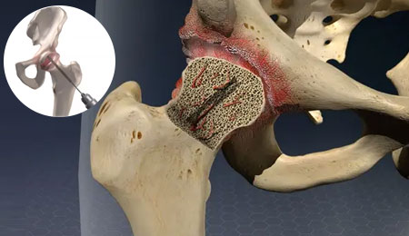 Regrow Therapy for Hip Preservation