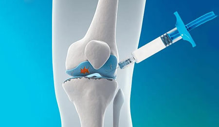 Viscosupplementation Therapy for Joint Preservation