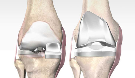 Microplasty Joint Preservation Procedure